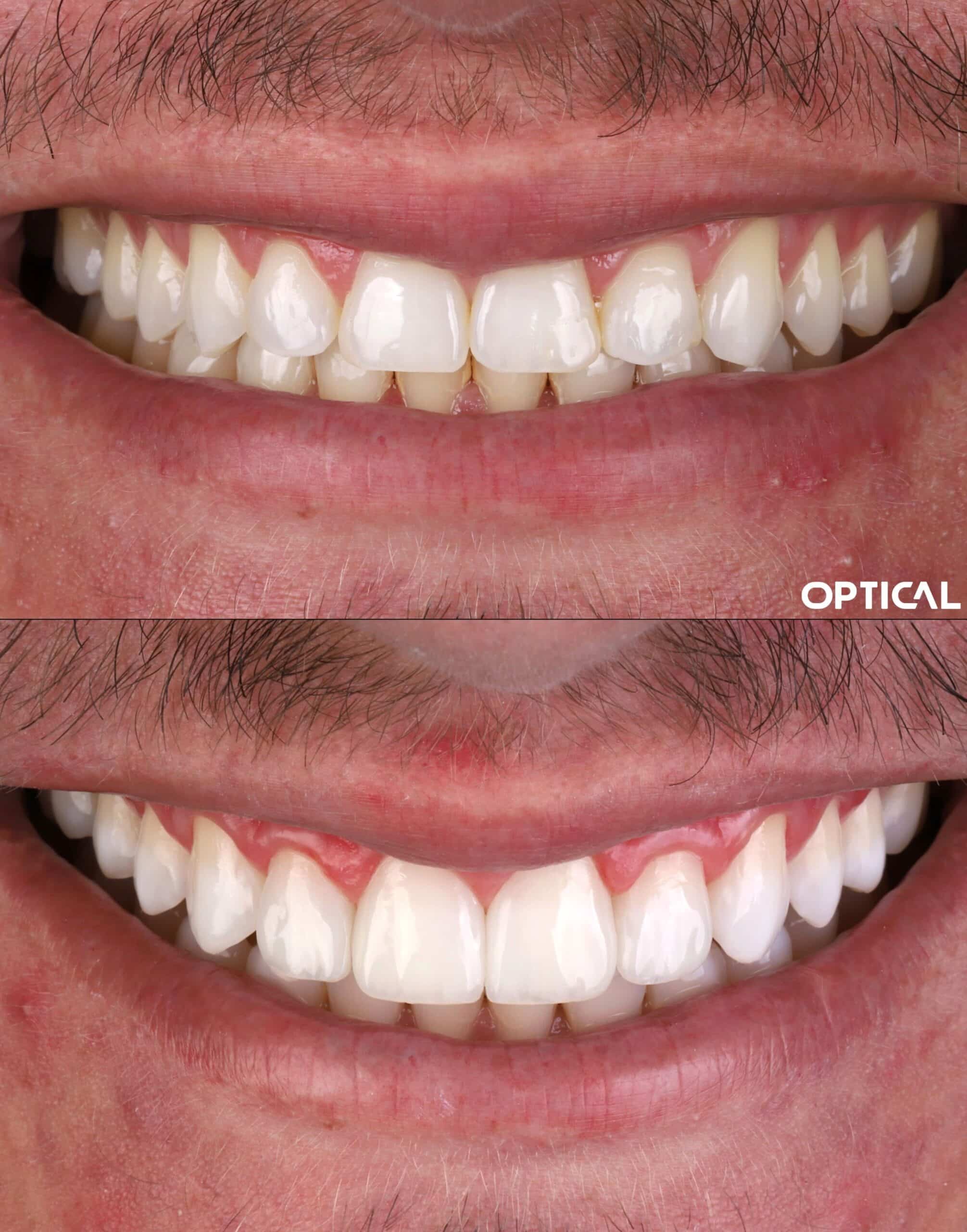 Aumento-de-borda-incisal-para-correcao-de-curva-do-sorriso-scaled-1-1.jpg