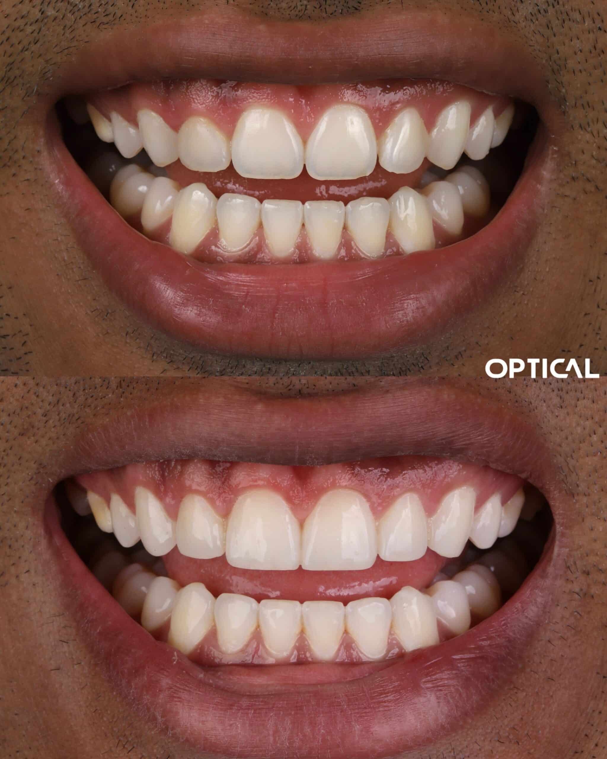 Modificando-a-morfologia-de-dentes-arredondados-para-dentes-quadrangulares-scaled-1-1.jpg