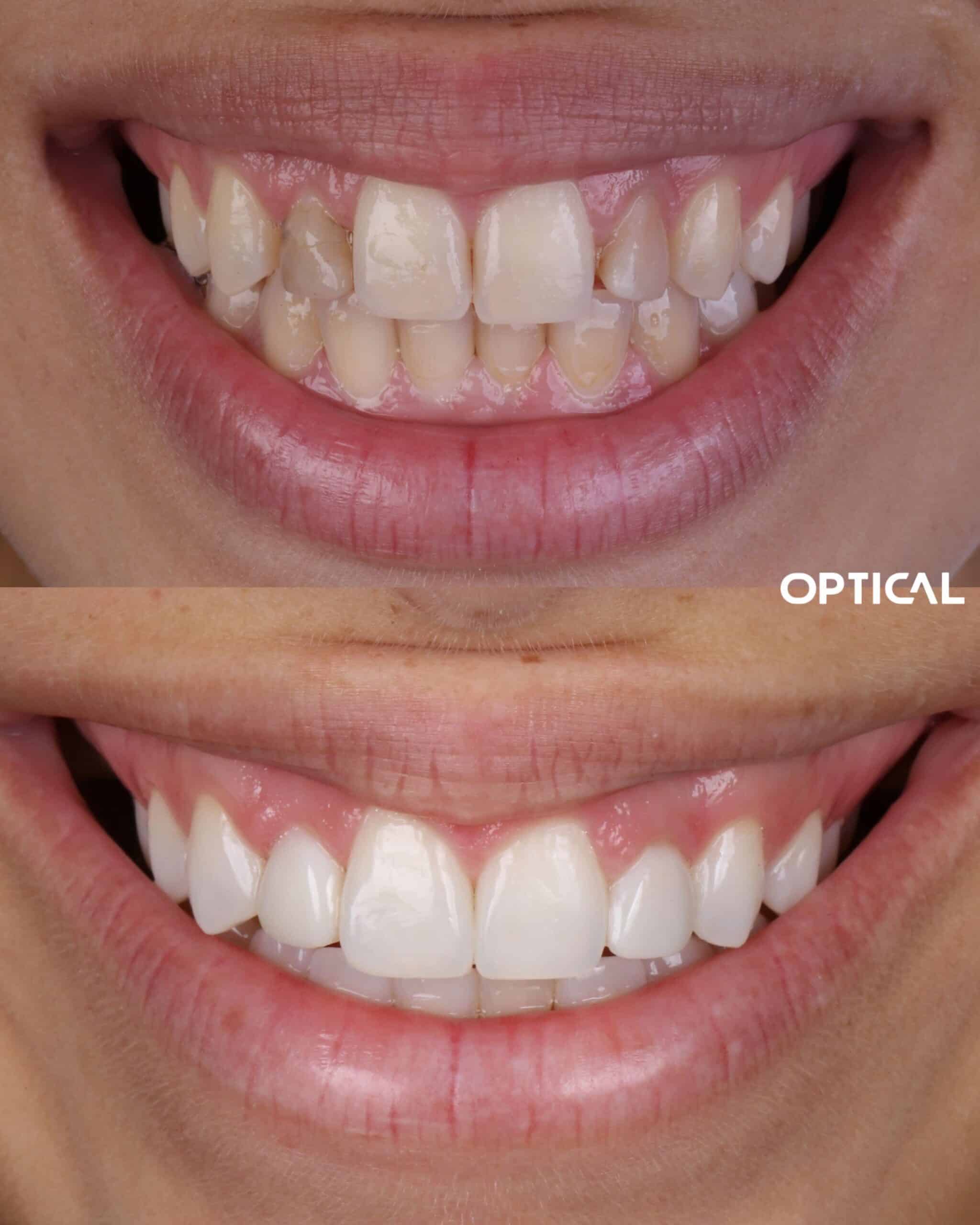 Restauracao-em-dentes-conoides-escurecidos-scaled-1-1.jpg